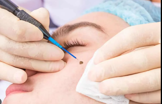 Mole Removal