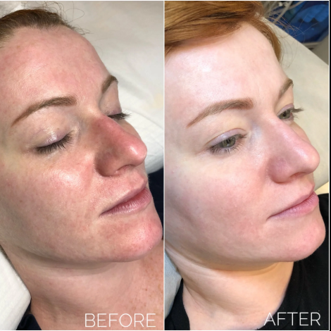BB Glow Facial